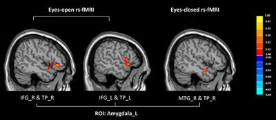 Aberrant Functional Connectivity between the Amygdala and the Temporal Pole in <mark class="highlighted">Drug-Free</mark> Generalized Anxiety Disorder